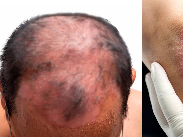 La atención temprana en psoriasis mejora el pronóstico y reduce complicaciones, según expertos