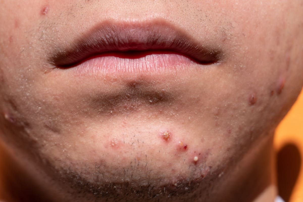 Cómo combatir el acné adulto masculino sin complicarse