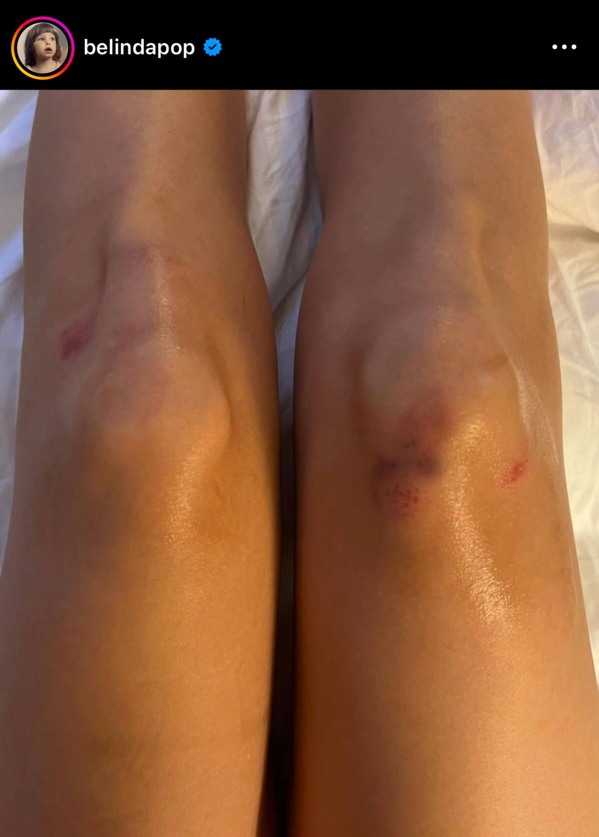 Belinda muestra sus moretes en redes.