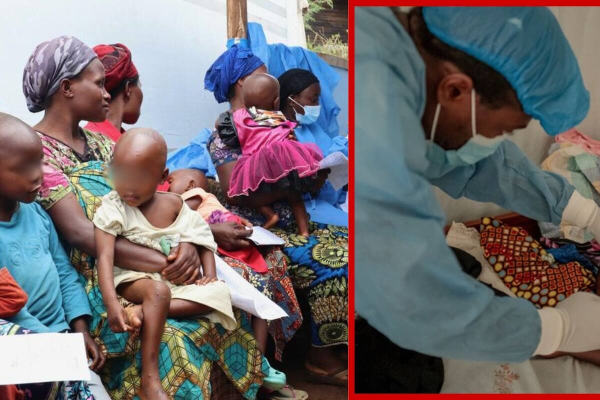 África en crisis por más de 50 mil casos y muertes por mpox