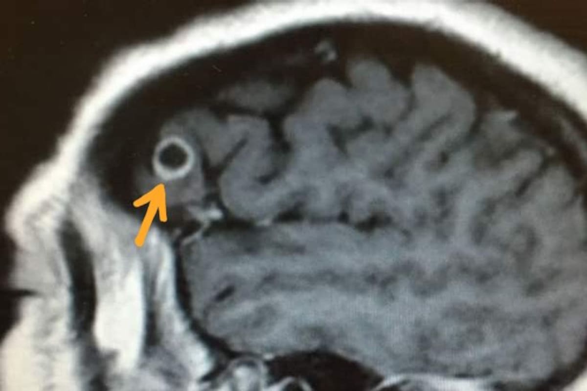 Esta mujer vivió con un gusano en su cerebro