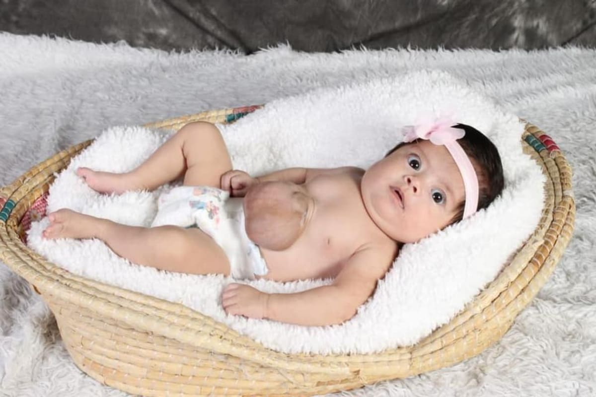 Nació con el corazón fuera de su cuerpo y sobrevivió pese a que los médicos le dieron nula esperanza de vida