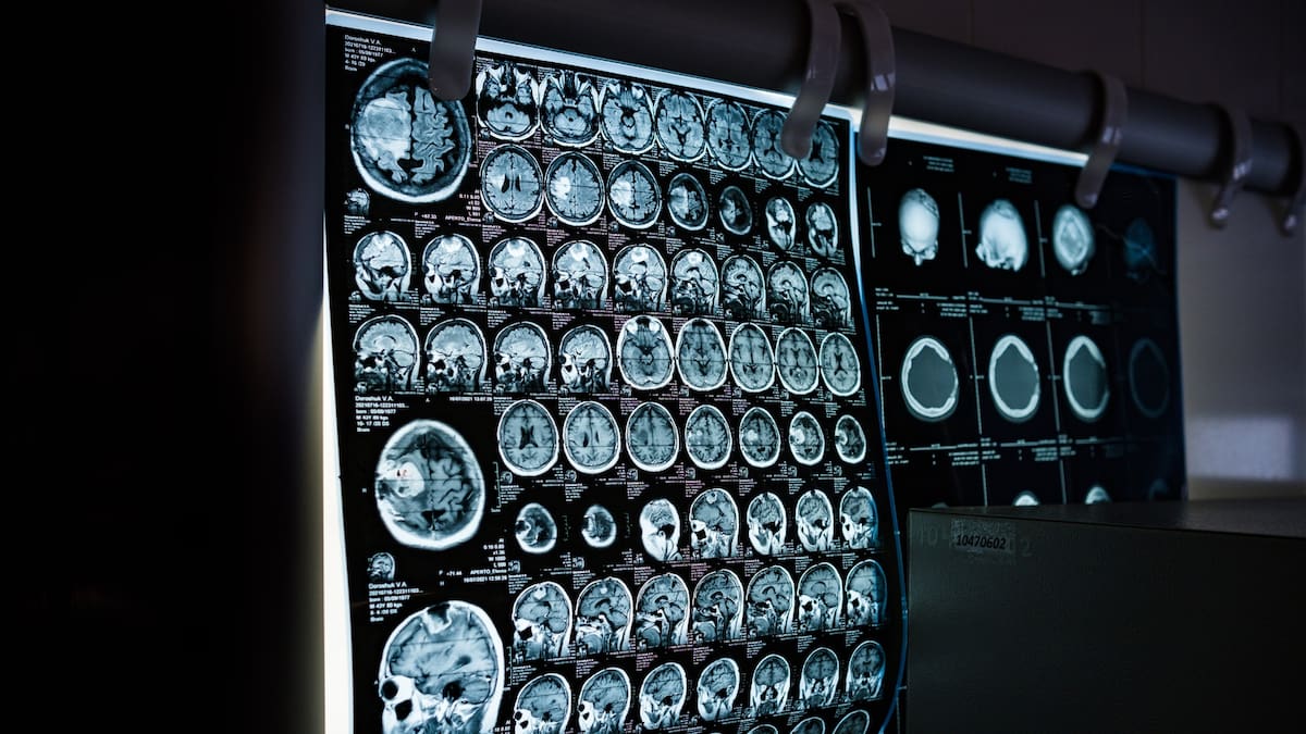 El fármaco uPAR CAR-T demostró ser capaz de destruir tanto las células cancerosas como el entorno que permite al tumor regresar tras la quimioterapia.