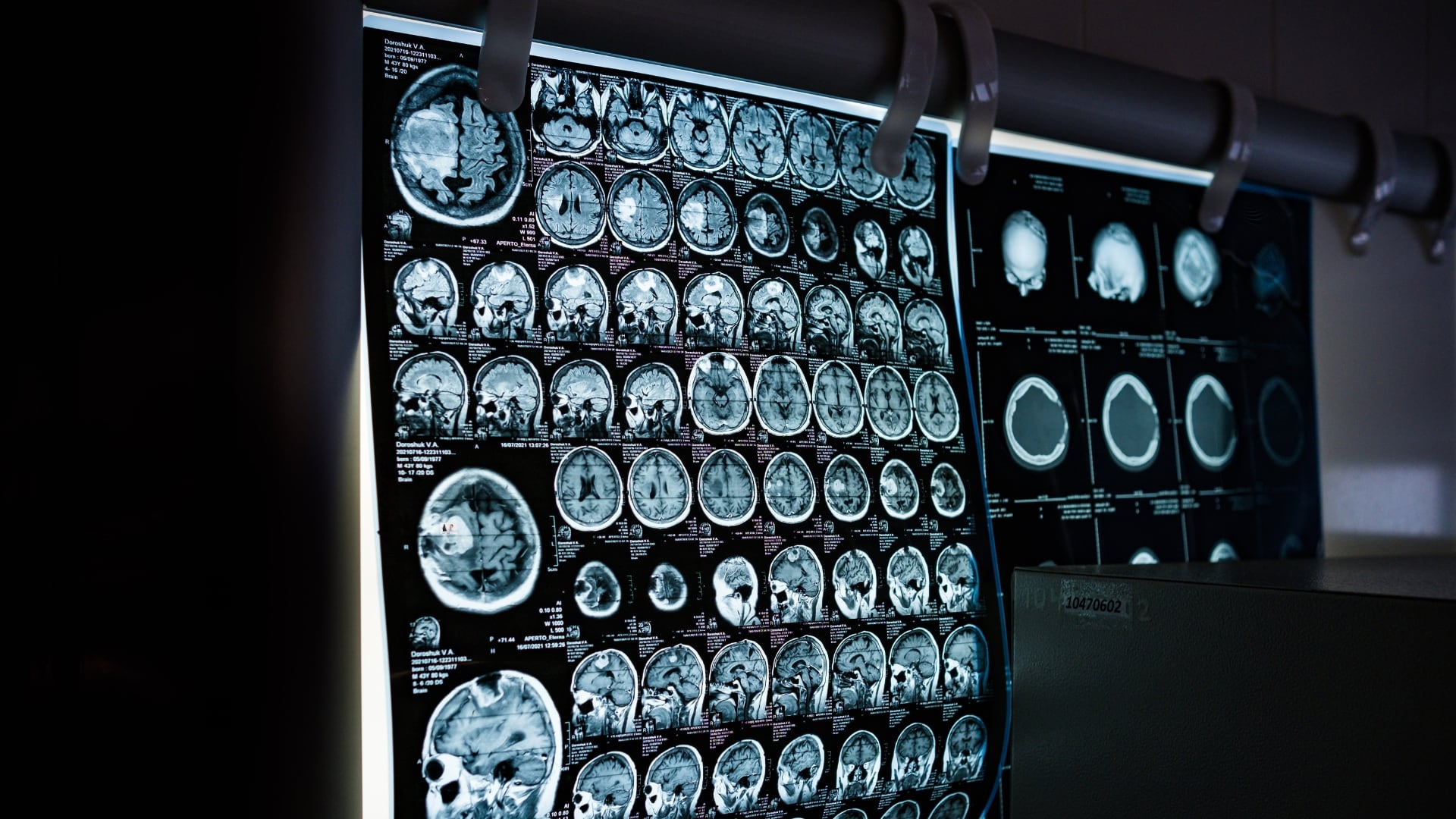 El fármaco uPAR CAR-T demostró ser capaz de destruir tanto las células cancerosas como el entorno que permite al tumor regresar tras la quimioterapia.