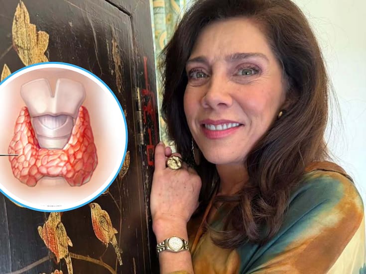 ¿Qué es la enfermedad de Hashimoto? La enfermedad incurable que Cynthia Klitbo reveló tener