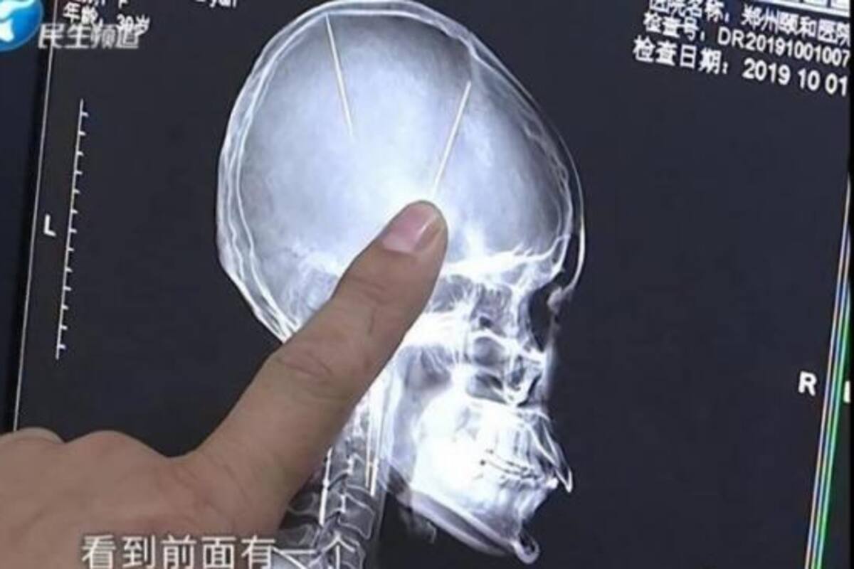 Con una tomografía por un accidente descubrió que tenía dos agujas en el cerebro