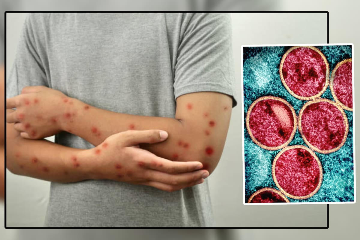 Alerta mundial de Mpox: OMS advierte sobre nuevos brotes de viruela del mono en Europa