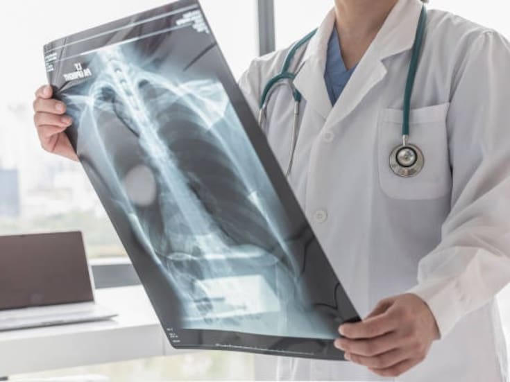 BC es el primer lugar nacional con más contagiosos de tuberculosis