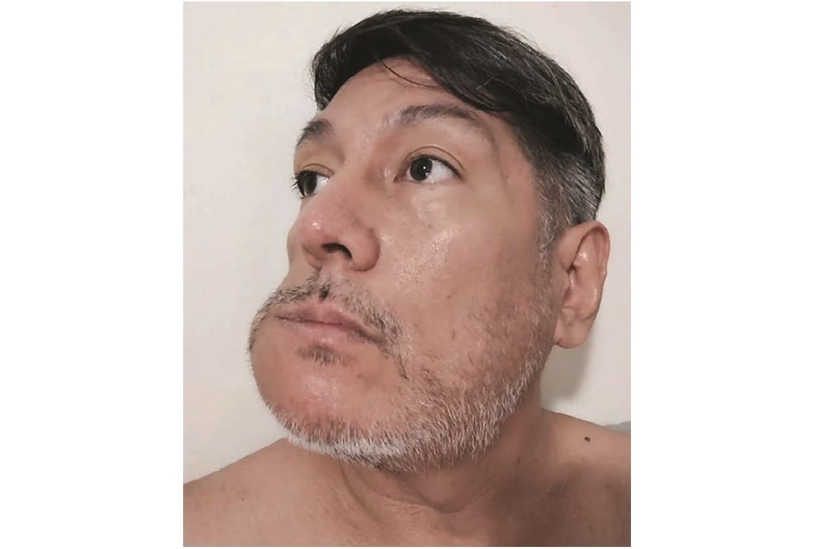 Hiram Kossio enfrenta el reto de un tumor benigno: El ameloblastoma que crece en la zona maxilar inferior prácticamente deshace los huesos de su rostro.
