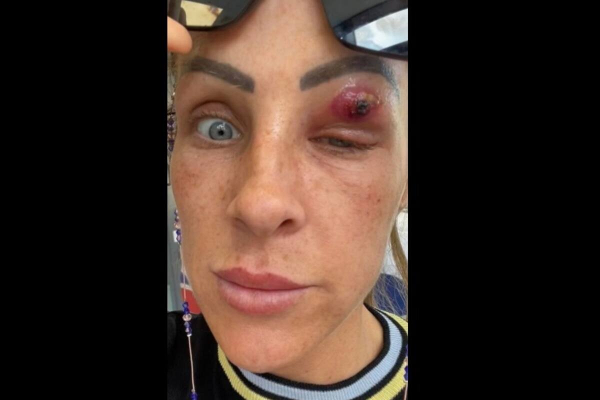 Creía que tenía un grano en el ojo, termina expulsando un parásito