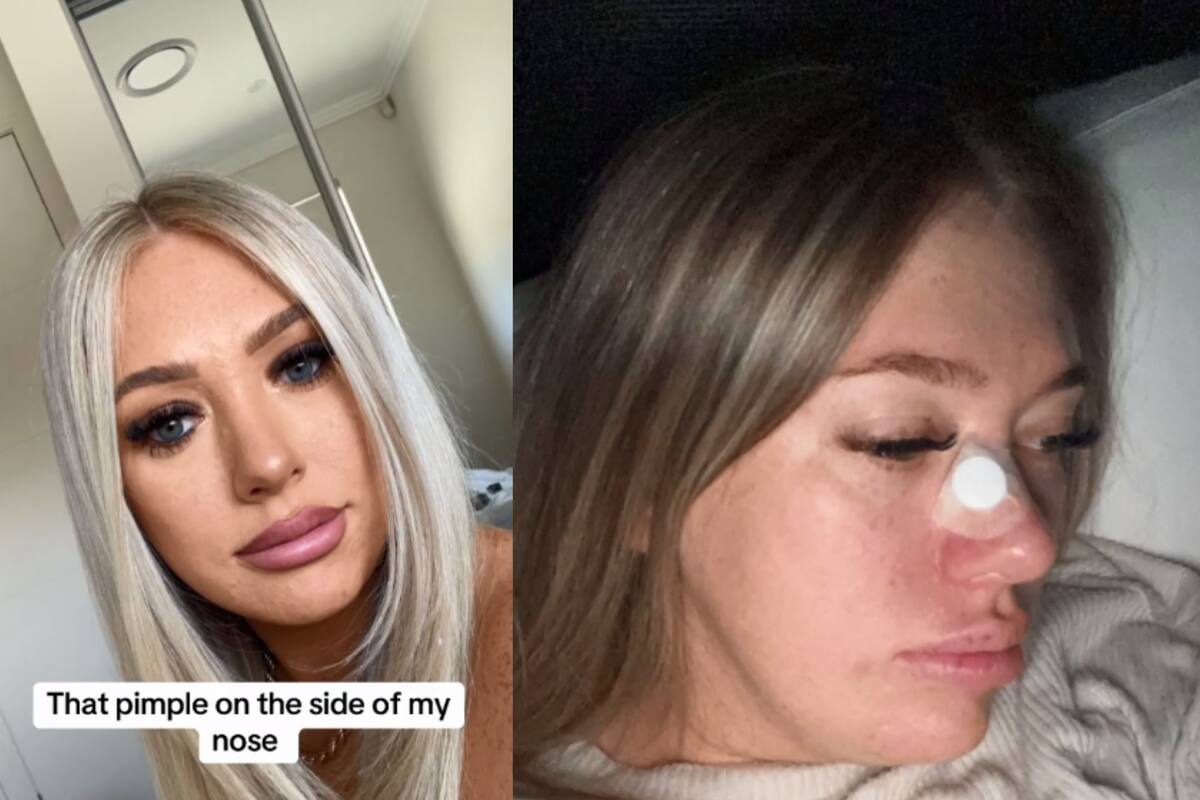 Mujer creía que tenía un “poro obstruido” pero resultó ser cáncer de piel: “Nunca piensas que esto te va a pasar a ti”