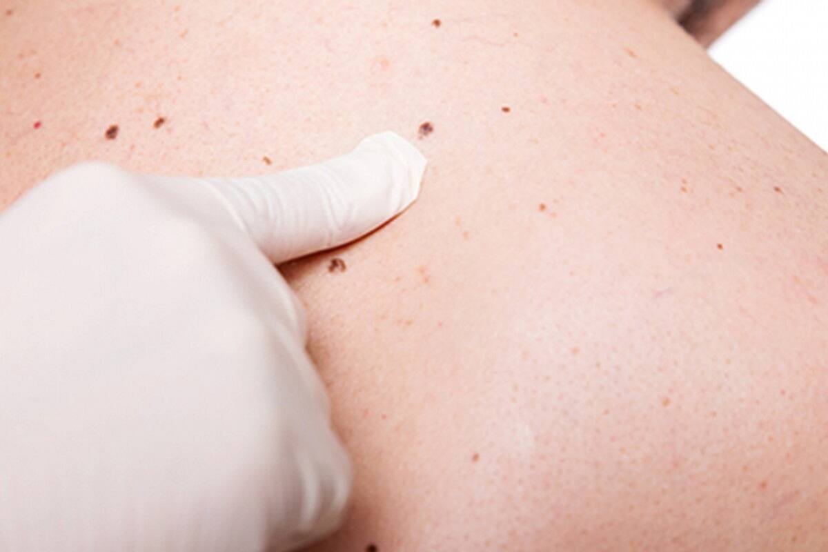 ¿Sabías que el melanoma puede estar oculto en tu cuerpo?