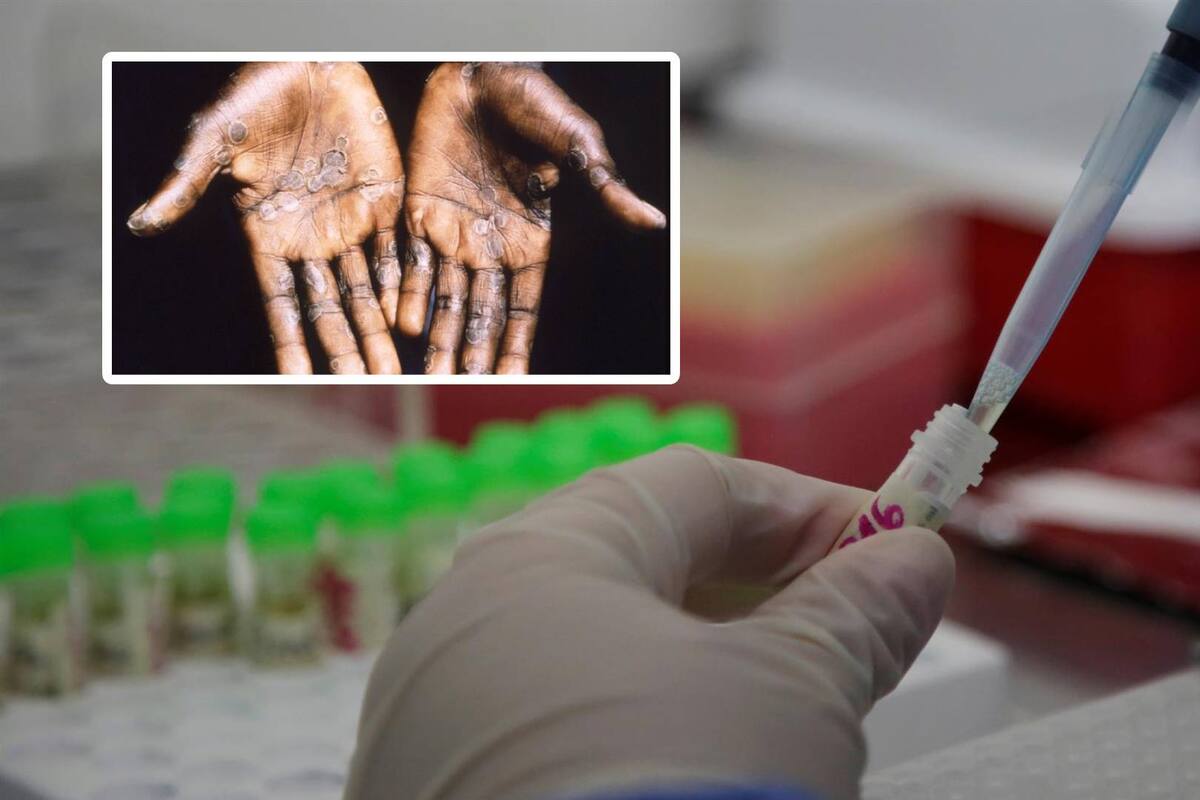 Aumentan a 386 los casos de viruela del mono en México: Secretaría de Salud