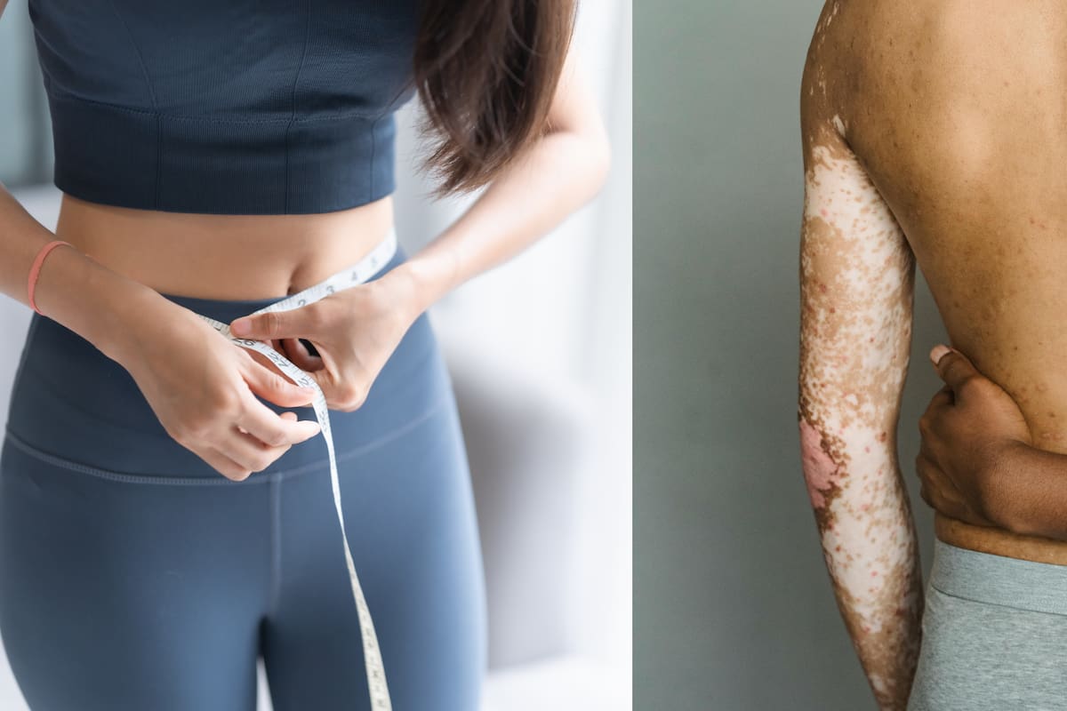 ¿Perder peso puede ser beneficioso para la psoriasis? Esto dicen nuevos análisis