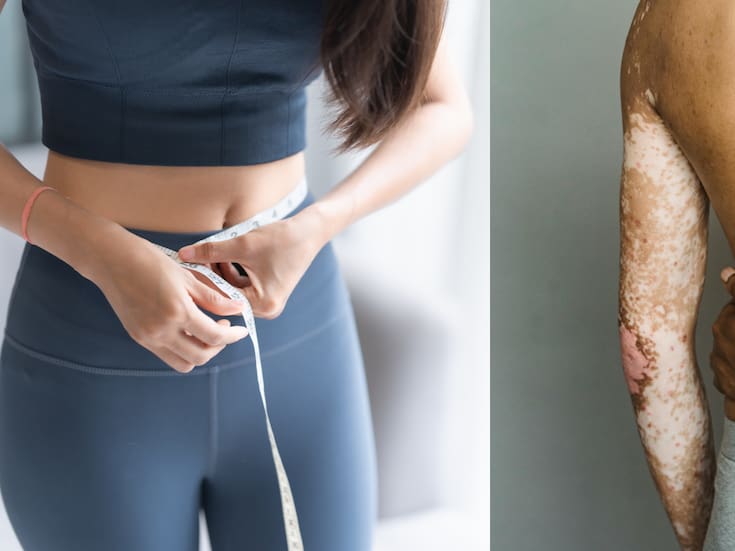 ¿Perder peso puede ser beneficioso para la psoriasis? Esto dicen nuevos análisis