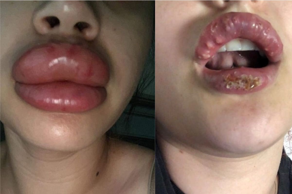 7 mujeres de Arizona resultan con pus y herpes al inyectarse los labios