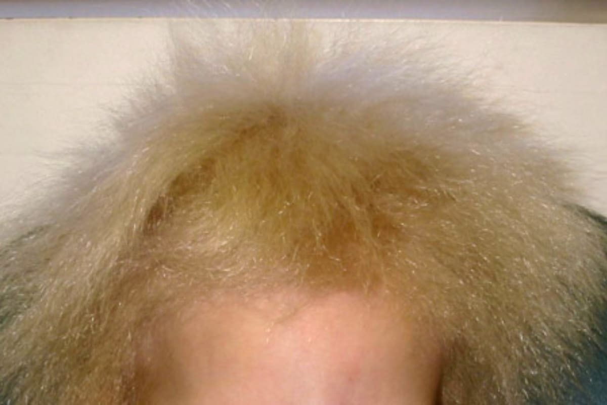 Síndrome del cabello impeinable, ¿lo conocías?