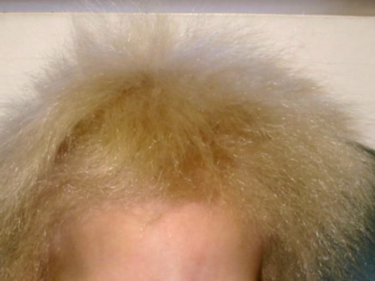 Síndrome del cabello impeinable, ¿lo conocías?
