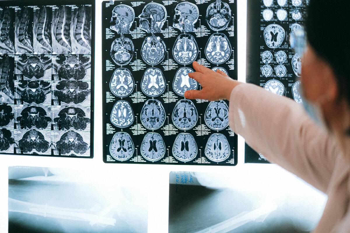¿Contagiarse de Covid provoca envejecimiento acelerado del cerebro? Esto indica un nuevo estudio