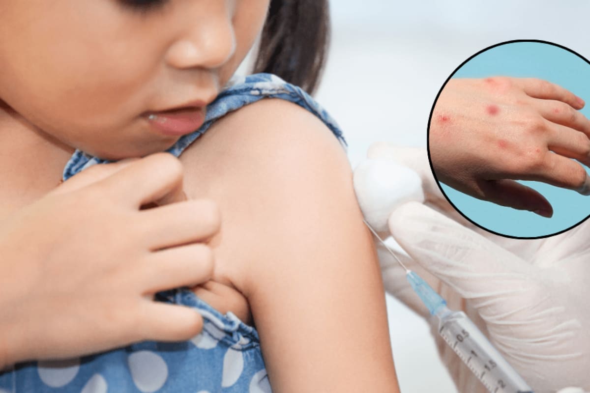 Suma sarampión más de 6 mil casos durante este año