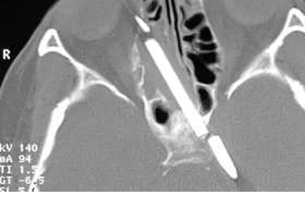 El misterioso objeto que descubrieron en su cabeza tras un dolor de cabeza persistente