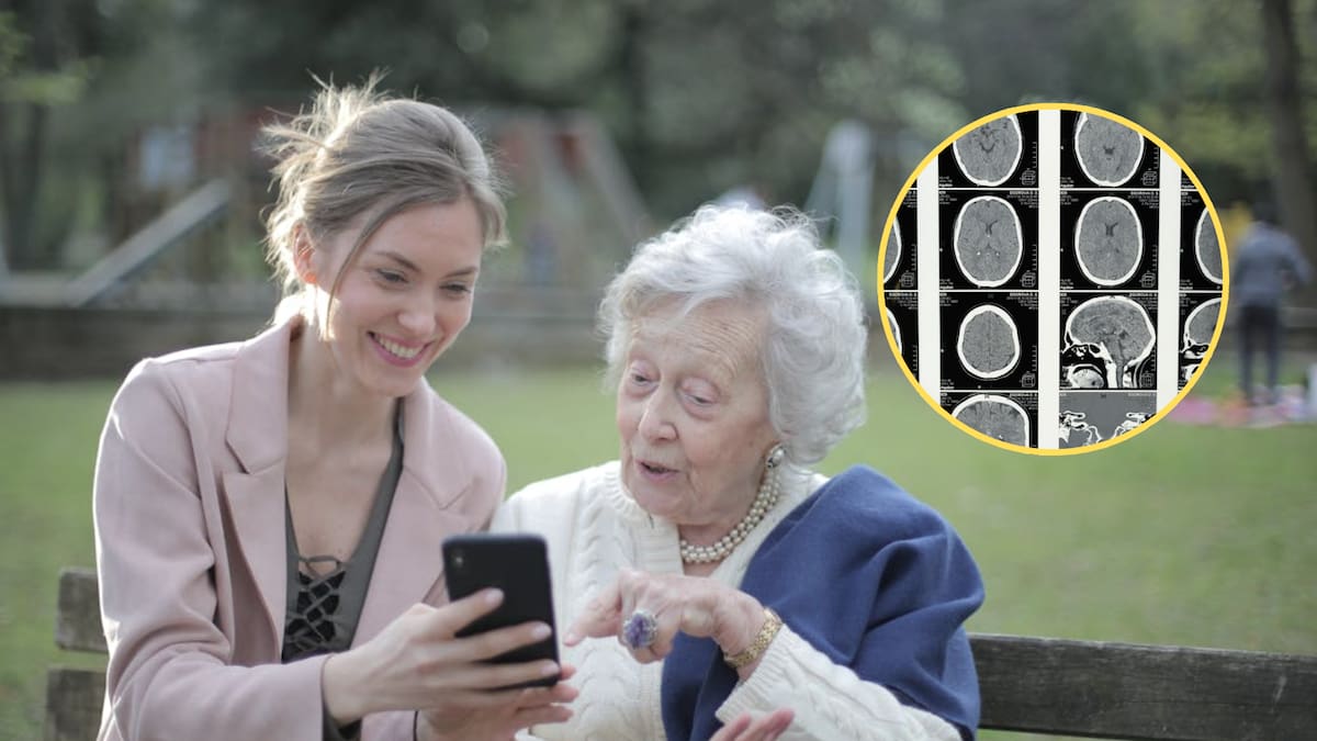 Científicos logran reducir el daño cerebral del Alzheimer al eliminar una proteína clave y observan mejoras en memoria