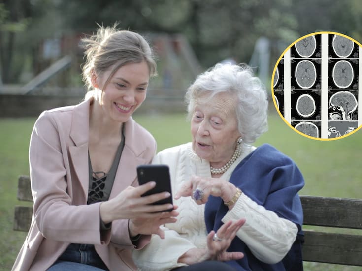 Científicos logran reducir el daño cerebral del Alzheimer al eliminar una proteína clave y observan mejoras en memoria