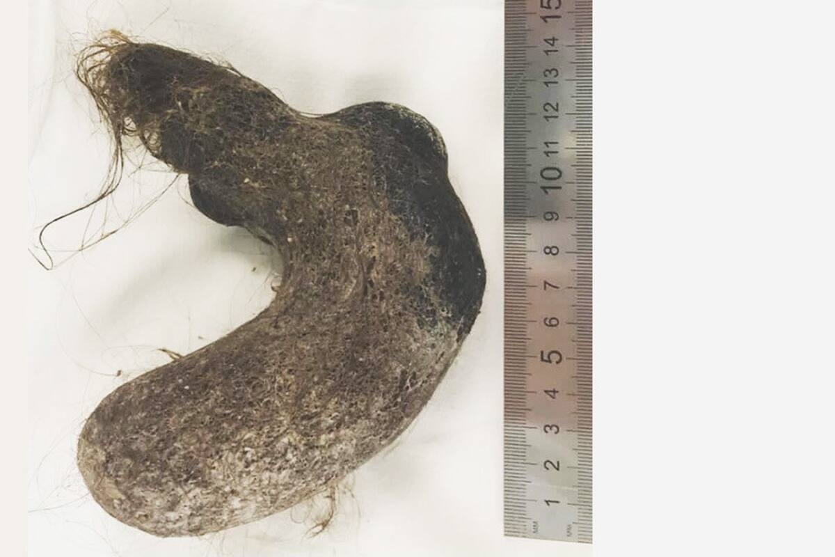 Extraen una bola de pelos del estómago de una niña de 12 años
