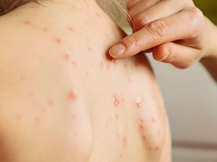 Aumentan 17% contagios de varicela en BC