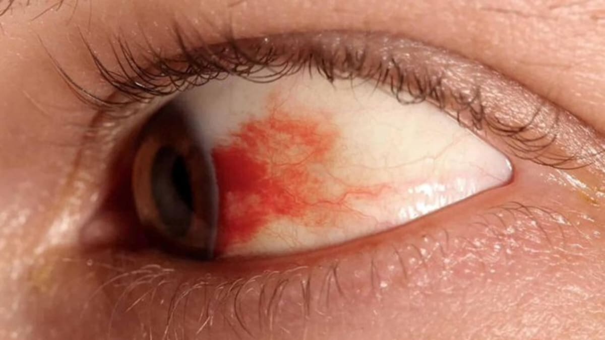 Investigadores de la UNAM desarrollan gotas oftálmicas que podrían reemplazar inyecciones en el tratamiento de la retinopatía diabética y prevenir la ceguera. /El Universal