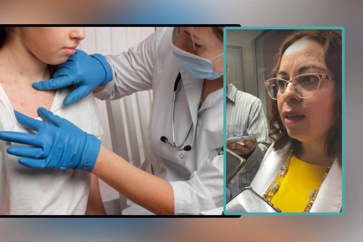 Mpox en Sonora: IMSS-Bienestar capacitará a personal médico para identificar y tratar la viruela del mono