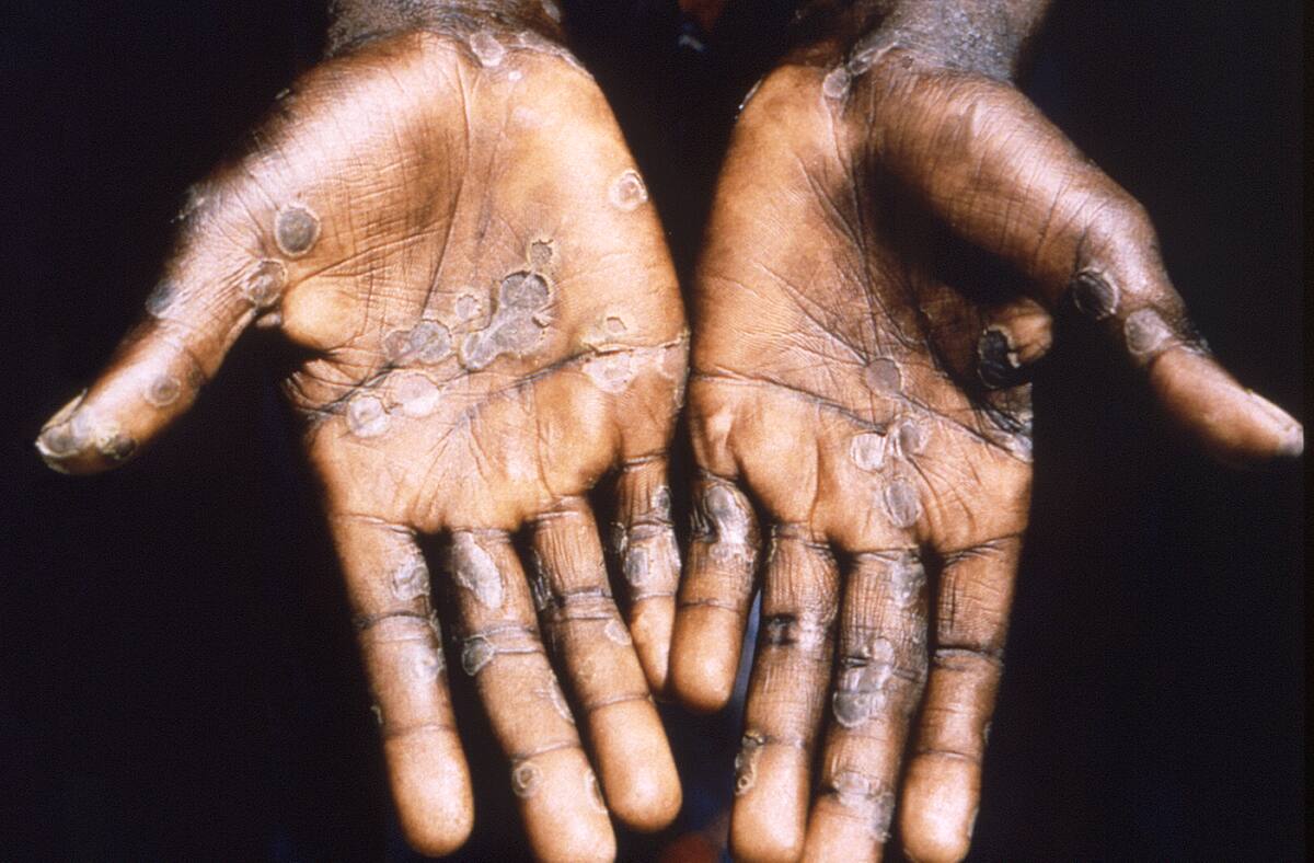 Imagen de las lesiones en la piel provocadas por la viruela del mono, durante un estudio llevado a cabo en la República Democrática del Congo entre los años 1996 y 1997. EFE/ Brian W.j. Mahy/Center for Disease Control and Prevention