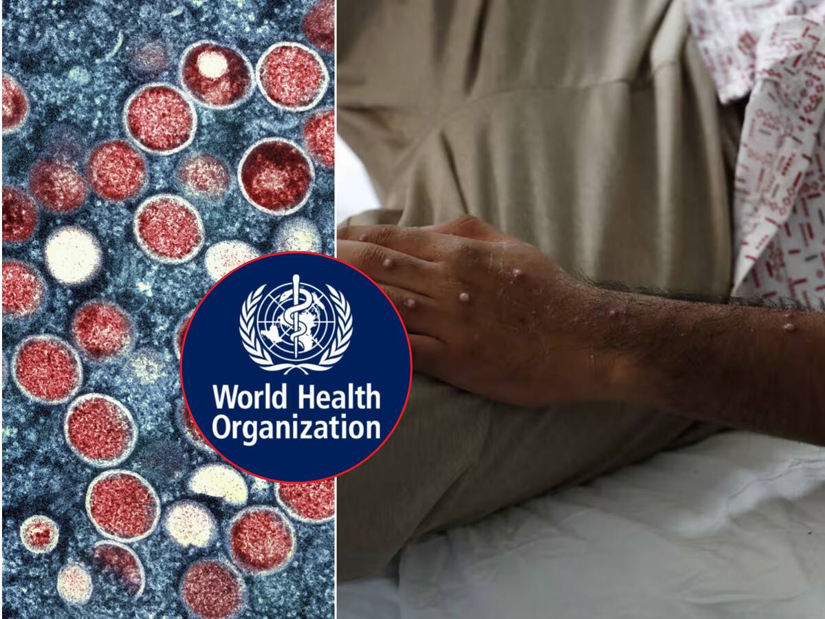 Se registra un incremento y mayor facilidad de contagios por Mpox. | Crédito: EFE/AP