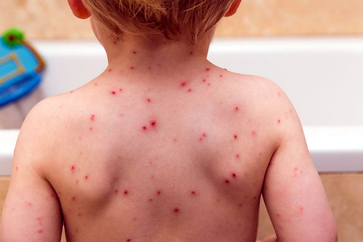 Varicela, ¿obligatoria o prevenible?