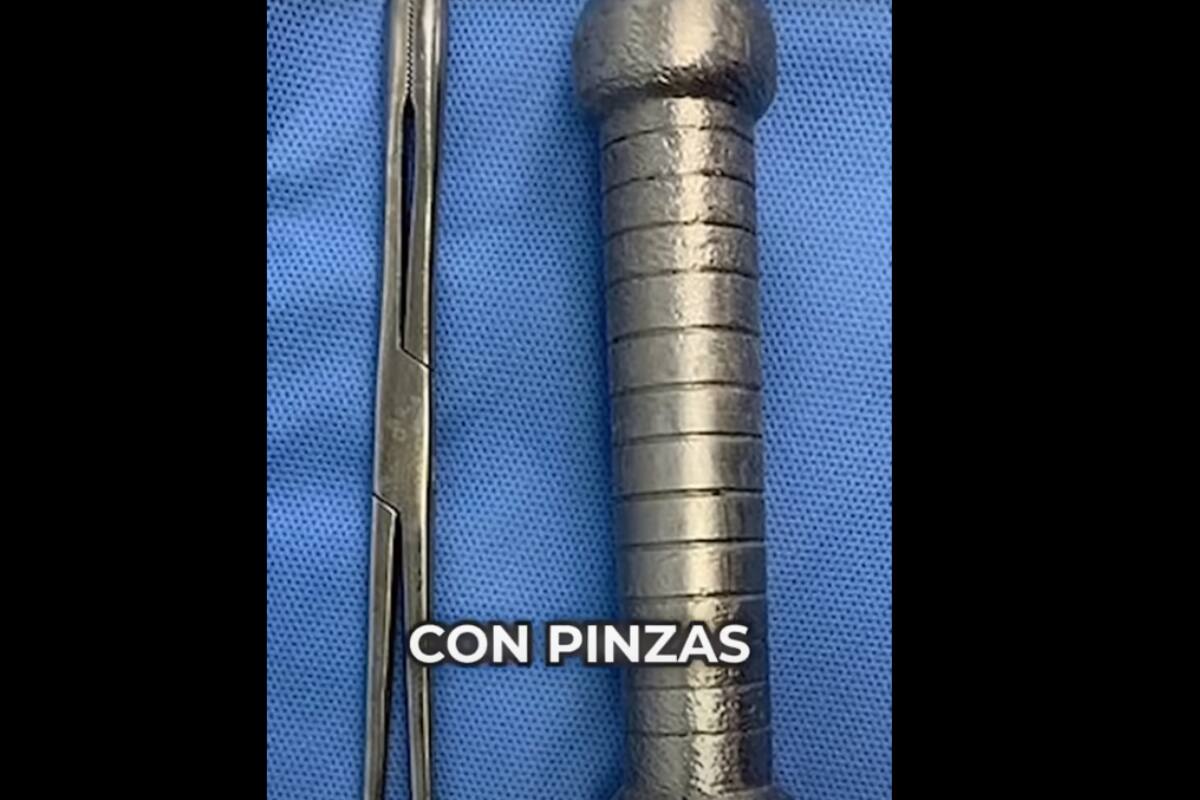 Insólito caso médico: Encuentran pesa de 20 cm en el intestino de un brasileño