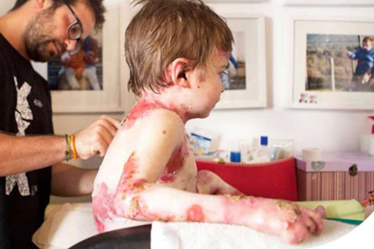 Espacialistas buscan visibilizar la “piel de mariposa”, promover el cuidado especializado y la inclusión en el Día Internacional de la Epidermólisis Bullosa