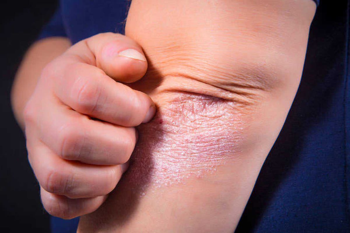 Pacientes con psoriasis, con mayor riesgo de padecer diabetes e hipertensión