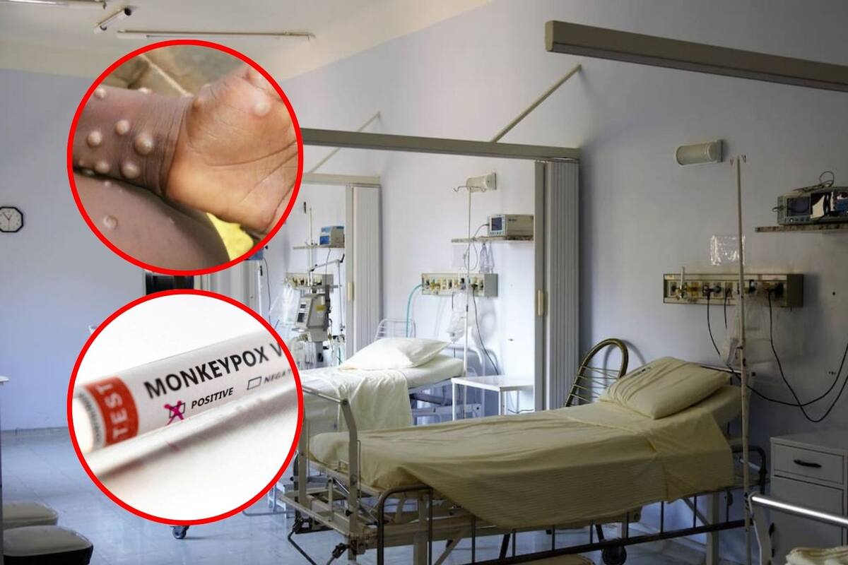 ¿Jóvenes o personas mayores? Este es el grupo con mayor riesgo de contraer viruela del mono