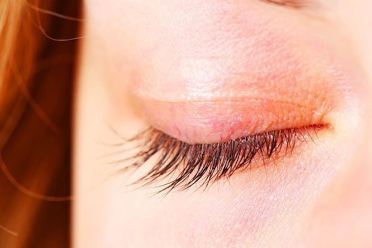 Por qué se manchan los párpados