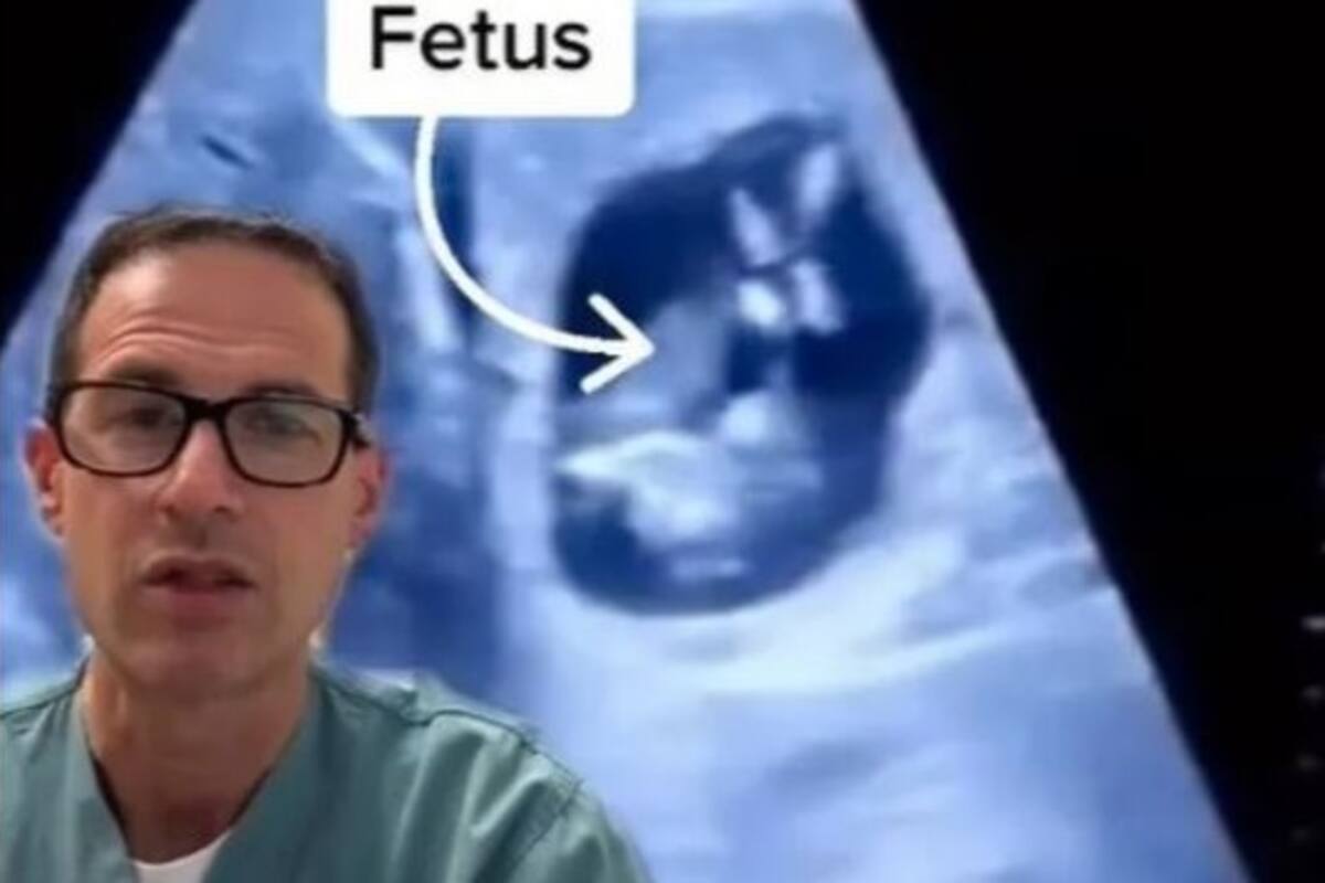 Descubren “bebé” creciendo en el hígado de una mujer