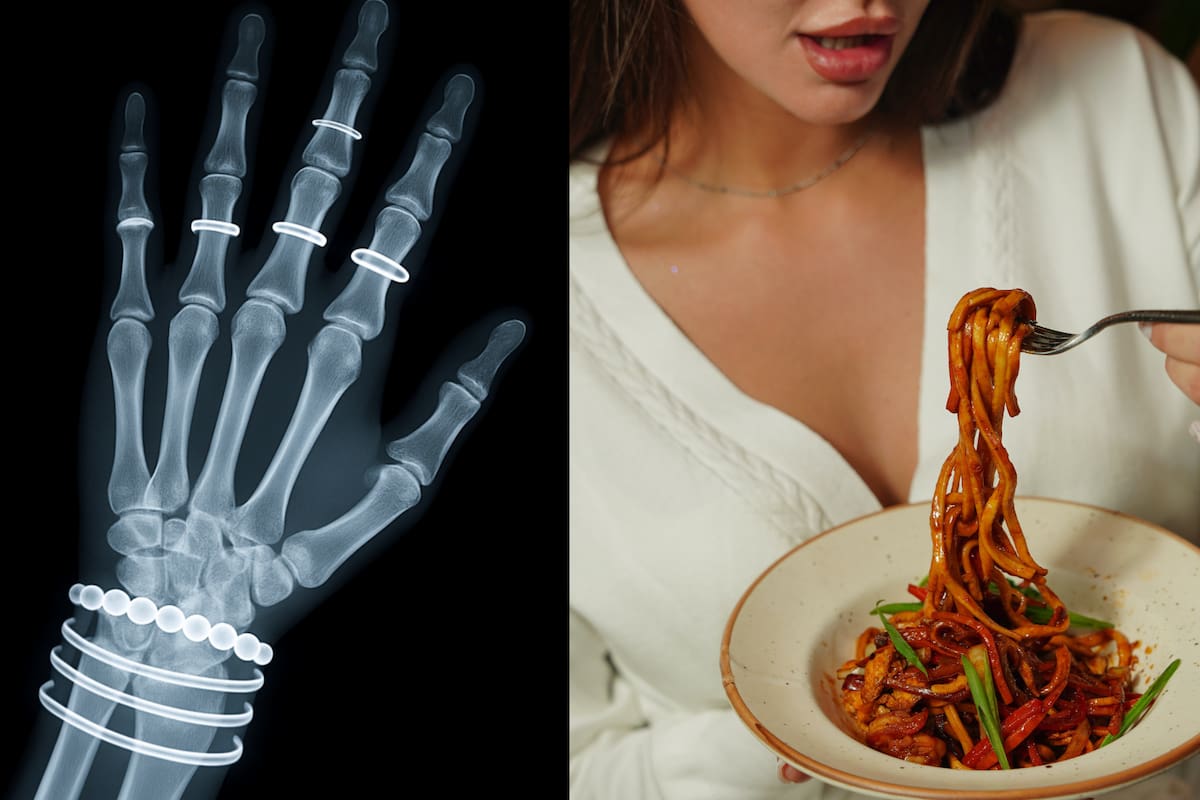 ¿Por qué algunas personas se fracturan más los huesos que otras? Esto dice la ciencia