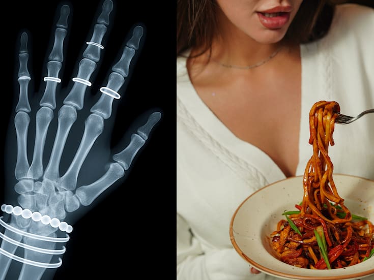 ¿Por qué algunas personas se fracturan más los huesos que otras? Esto dice la ciencia