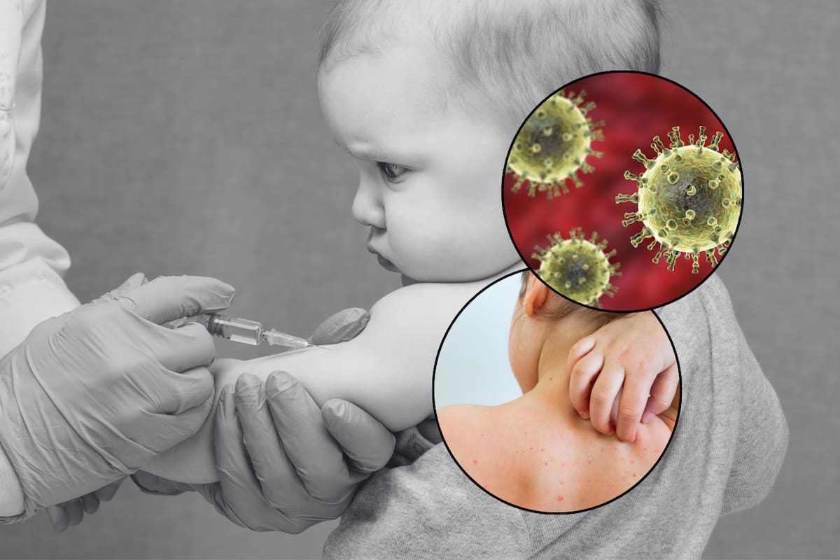 Sonora registra 854 casos de varicela en 2025; niños de 5 a 9 años son los más afectados