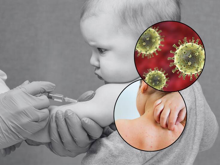 Sonora registra 854 casos de varicela en 2025; niños de 5 a 9 años son los más afectados