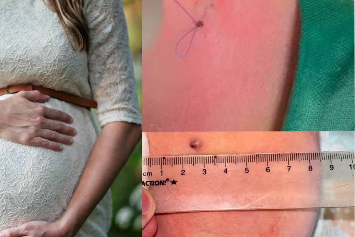 Bebé nace con perdigón de rifle luego que su madre recibiera disparo de su pareja durante el embarazo