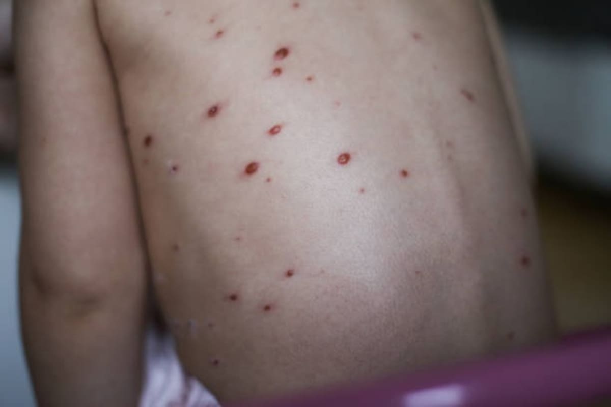 Tres casos de sarampión de la escuela primaria Educadores México aún no son confirmados