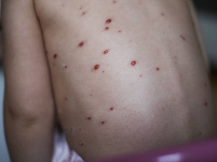 Tres casos de sarampión de la escuela primaria Educadores México aún no son confirmados