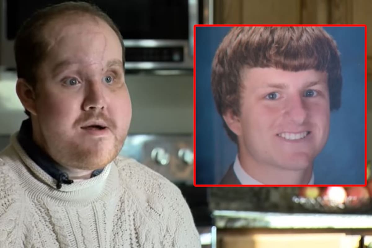 La increíble historia de Derek Pfaff, el hombre que recibió un trasplante de rostro tras un intento de suicidio fallido