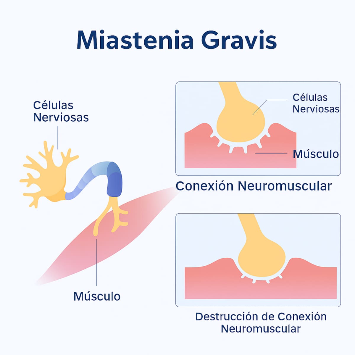 Miastenia Gravis.