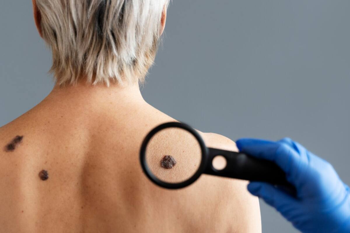 Cáncer de piel crece en México: Capacitarán a médicos de primera línea